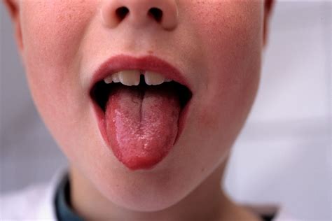 What Is Scarlet Fever Symptoms Rash How It Spreads And Affects Adults Metro News