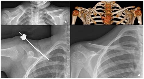 Congenital Pseudarthrosis Of The Clavicle A Report On 27 Cases