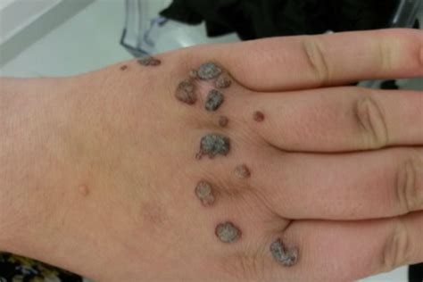 Everything You Need To Know About Warts Sterex