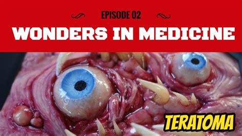 Wonders In Medicine Episode 2 Teratoma Youtube