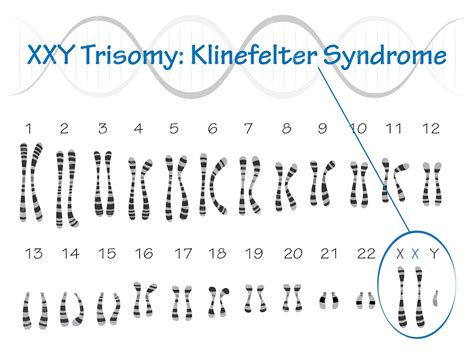 Premium Vector Klinefelter Syndrome Karyotype Vector Illustration