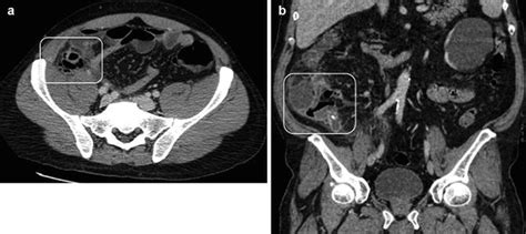 Acute Perforated Appendicitis Spectrum Of Mdct Findings Radiology Key
