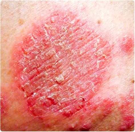 Nummular Eczema Pictures