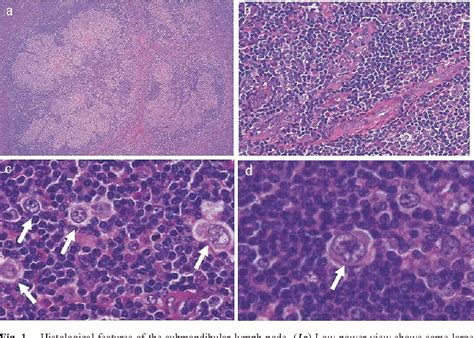 Pdf Classical Hodgkin Lymphoma Occurring In Association With