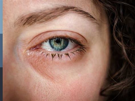 Corneal Abrasion Potential Causes Symptoms And Risks