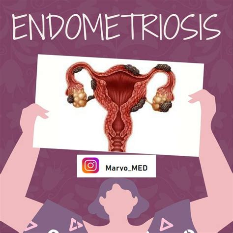 Cáncer de endometrio Busca y descarga apuntes gratis uDocz