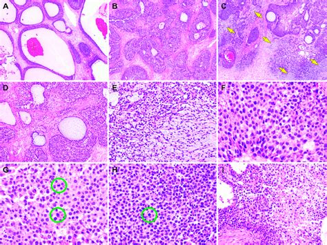 Histological Findings Of The Juvenile Granulosa Cell Tumor Jgct