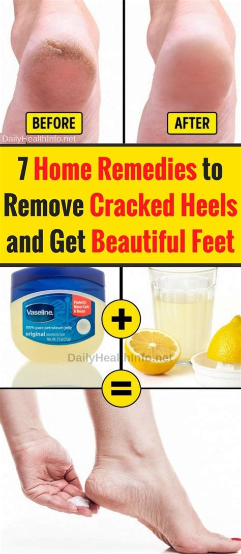 Dry Cracked Feet And How To Fix Themsteve Needs To Do This