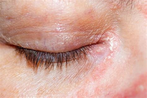 Atopic Dermatitis On The Eyelids Atopic Skin Eucerin