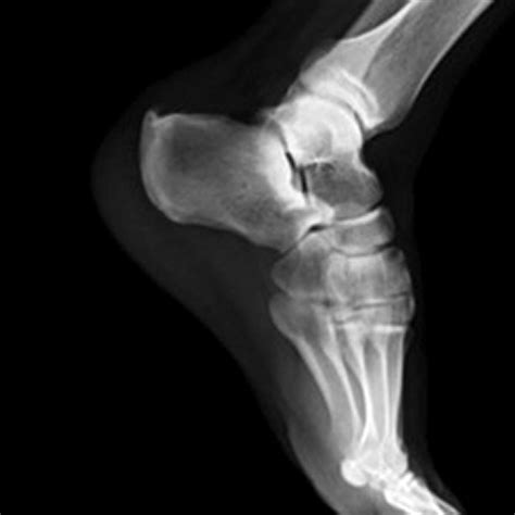 Preoperative Lateral Radiograph Showing Haglunds Deformity Fig 3