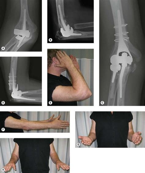 The Management Of The Failed Total Elbow Arthroplasty Musculoskeletal Key