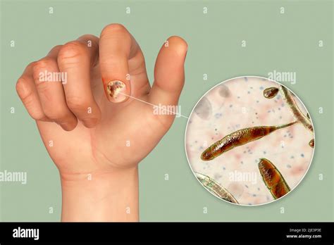 Illustration Of A Fungal Nail Infection Showing Human Hand With