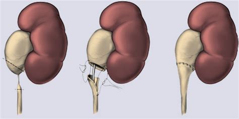 What Is Ureteropelvic Junction Obstruction