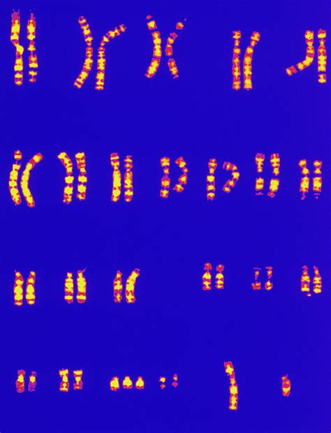 Col Karyotype Of Chromosomes In Downs Syndrome Photograph By L