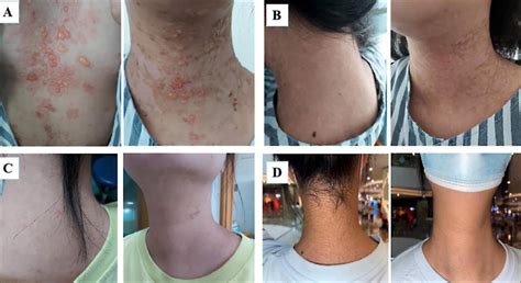 Changes In The Patients Bullous Skin Lesions Before And After