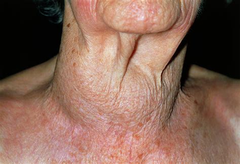 Thyroid Cancer Pictures Neck How Serious Is Thyroid Cancer Quora