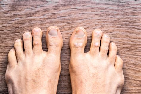 Feet Of Barefoot Man With Psoriasis Dermatitis On His Fingers Stock
