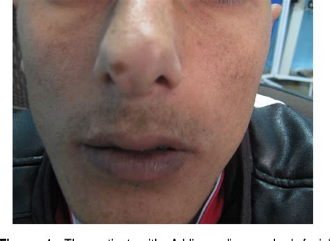 Facial Hyperpigmentation In A Male Patient Is The First Presentation Of