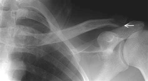 Clavicle Fractures Allman And Neer Classification Journal Of
