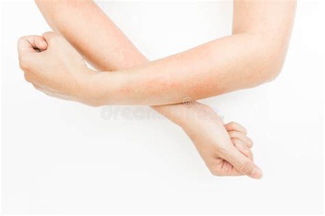 Red Rash On Arms Caused By Allergies Stock Photo Image Of Limb Skin