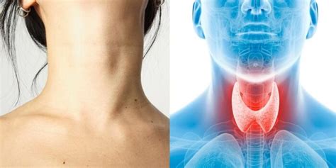 Glanda tiroidă mărită Cauze simptome și tratament SuntMamica com