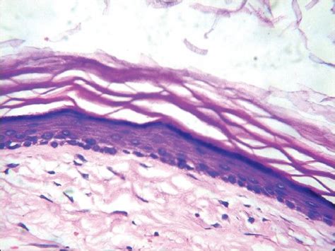 Histopathologic Features Showing Orthokeratinized Stratified Squamous
