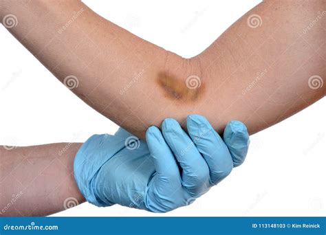 Bruise On Forearm From An Accident Stock Image Image Of Emergency