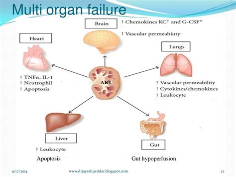 Multi Organ Dysfunction Syndrome