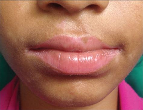 Lesions On Inside Of Lip