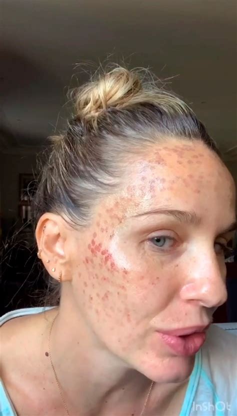 Star Shows 2nd Degree Burns After Skin Laser Treatment