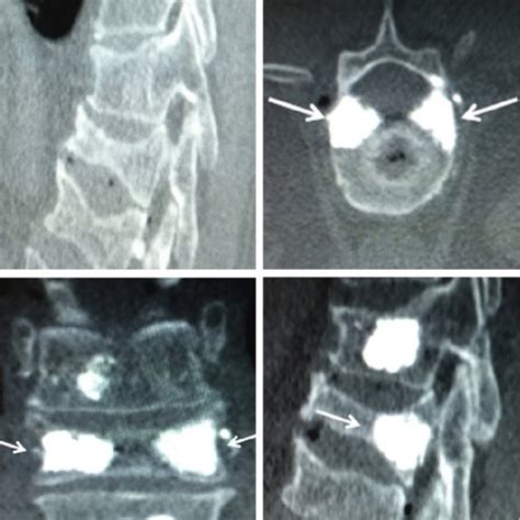 Patient With Fracture Of T12 Vertebral Body Ct Scan Of The Lumbar