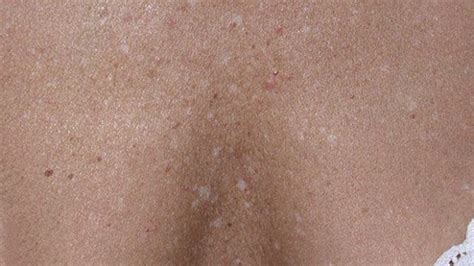 Critique La Faillite Quelque Peu White Spots On Tan Skin Civilisation