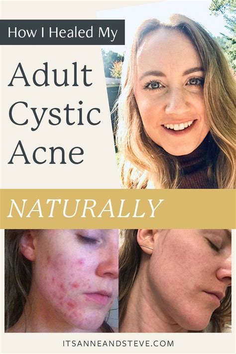 How I Cleared My Adult Cystic Acne Naturally By Trusting My Body Artofit