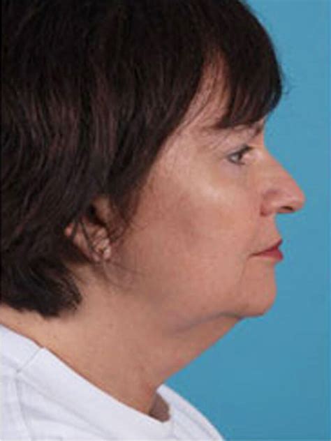 Face Lift Utah Mobley Md Facial Plastic Surgeon