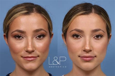 Lip Augmentation Before And After Photo Gallery Palo Alto And San Jose