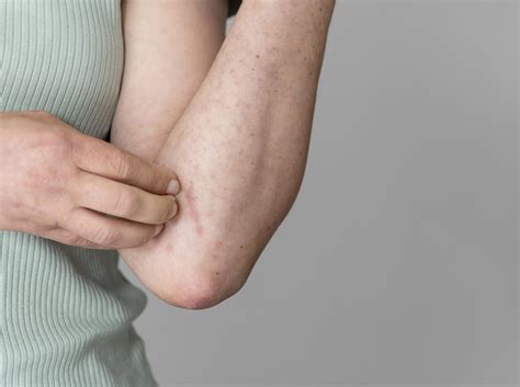 Dermatite da sudore o sudamina i sintomi e i rimedi più efficaci Farmacia Roma Est