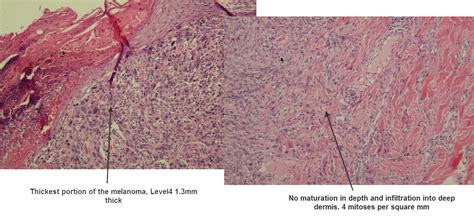 Dermpath Made Simple Neoplastic Melanoma Superficial Spreading And