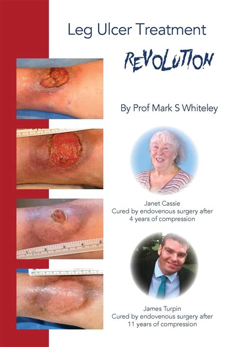 Leg Ulcer Treatment Revolution Paperback