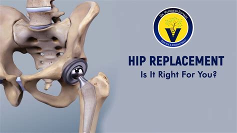 Hip Replacement Is It Right For You Orthopedic Hip Surgeon Youtube