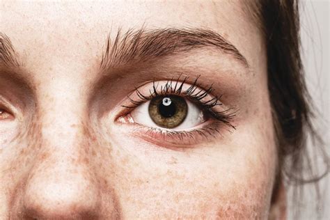 Yes Eye Freckles Are A Thing—and Heres What They Can Tell You About