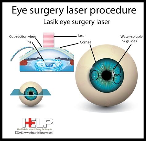 A less frequently used procedure called extracapsular cataract extraction requires. Eye Surgery Laser Procedure | Eye | Pinterest | Eyes