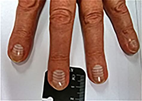 They can also appear in patients mees' lines will eventually grow out on their own, so there's no need for treatment of the lines themselves. Nail changes | The BMJ