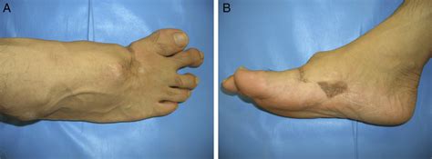 A And B Preoperative Clinical Photographs Showing Medial Deviation Of