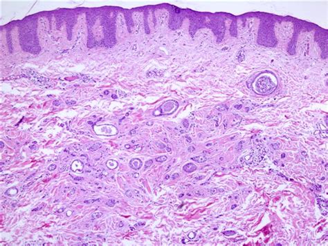 Pathology Outlines Syringoma