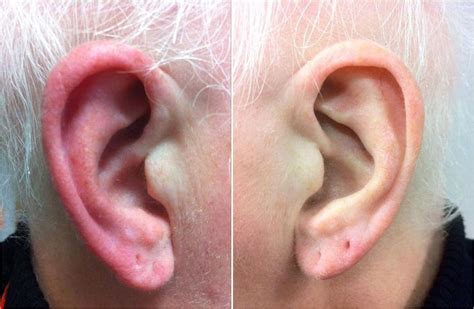 Red Ear Syndrome Wikipedia Syndrome Ear Symptoms