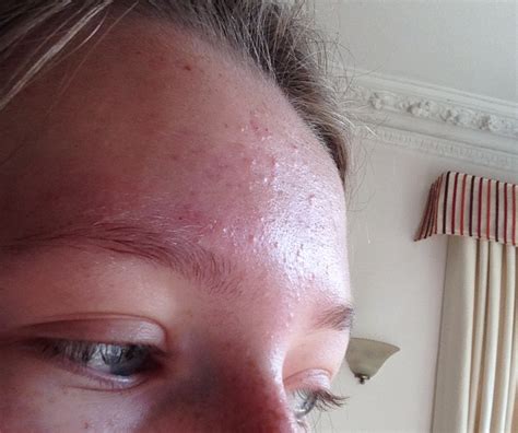 Mild To Moderate Forehead Acne General Acne Discussion Acne Org