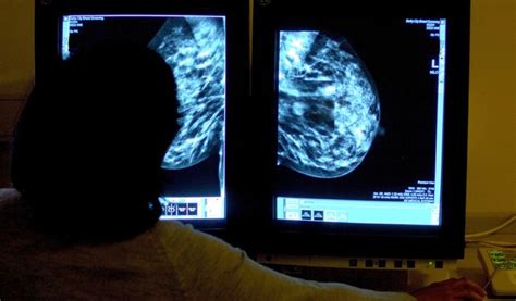 More Women With Breast Cancer Could Skip Harsh Radiation Study Says Wsj