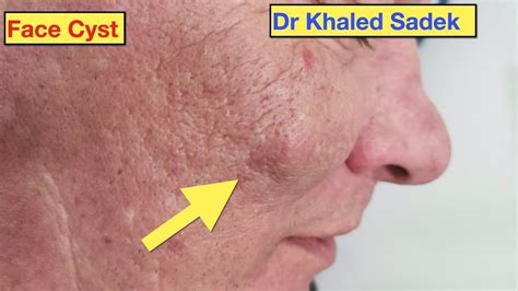 Cheeky Face Cyst Removal Dr Khaled Sadek Youtube