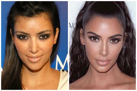 Kim Kardashian Plastic Surgery Before And After