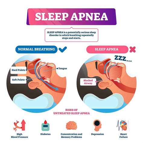 4 Signs That You Have Sleep Apnea